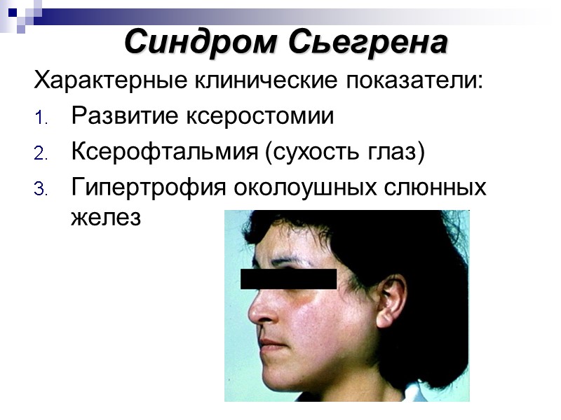 Синдром Сьегрена Характерные клинические показатели: Развитие ксеростомии Ксерофтальмия (сухость глаз) Гипертрофия околоушных слюнных желез